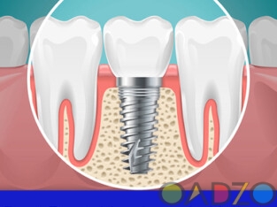 Dental Implant In Kolkata |